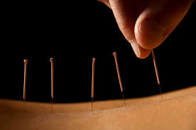 How to Find the Best Acupuncturist in Melbourne