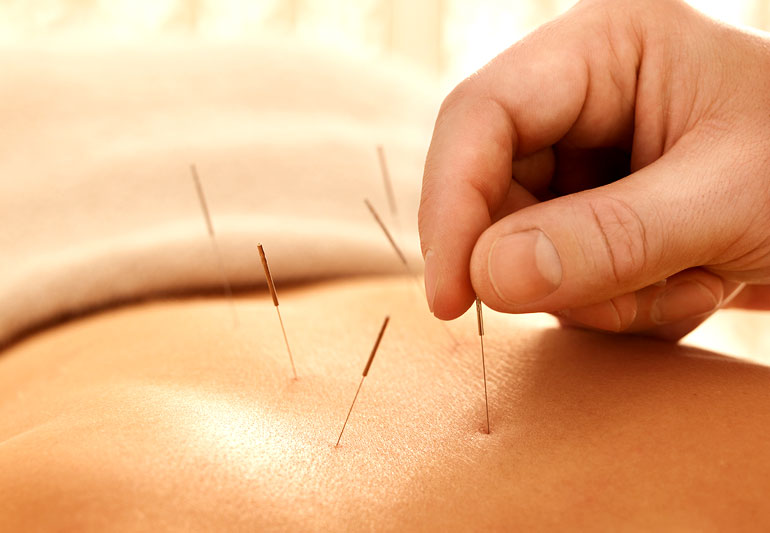 Tips To Help You Find A Good Acupuncturist