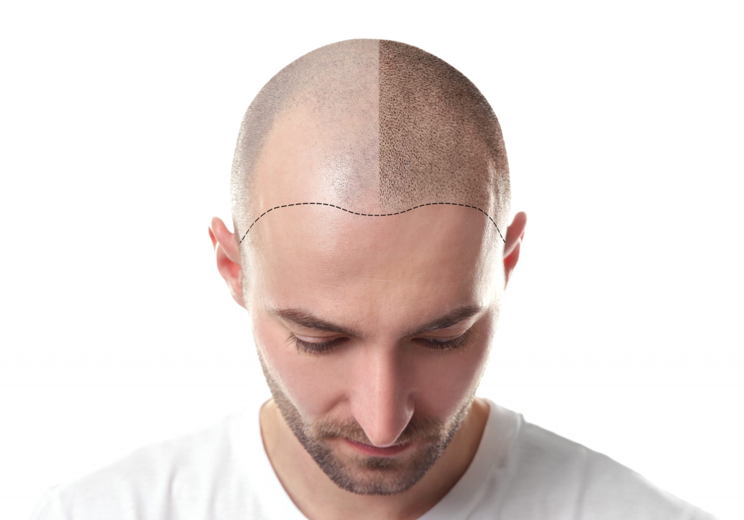 Scalp Micropigmentation Sydney is a Safe, Non-Surgical Treatment for Hair Loss